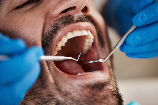 Best Dentist for Tooth Abscess  in Presquille, LA